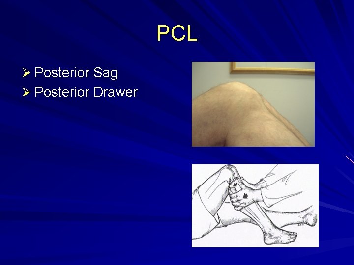 PCL Ø Posterior Sag Ø Posterior Drawer 