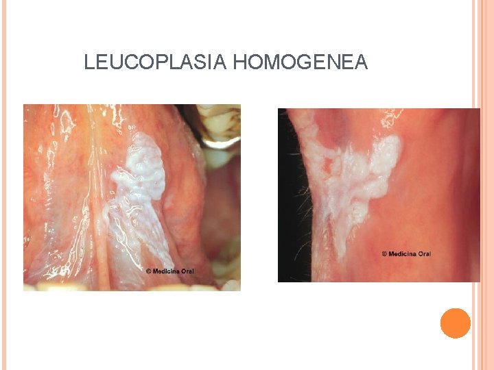 LEUCOPLASIA HOMOGENEA 