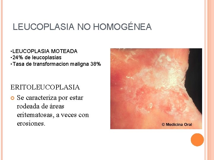 LEUCOPLASIA NO HOMOGÉNEA • LEUCOPLASIA MOTEADA • 24% de leucoplasias • Tasa de transformacion