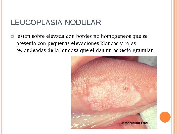 LEUCOPLASIA NODULAR lesión sobre elevada con bordes no homogéneos que se presenta con pequeñas