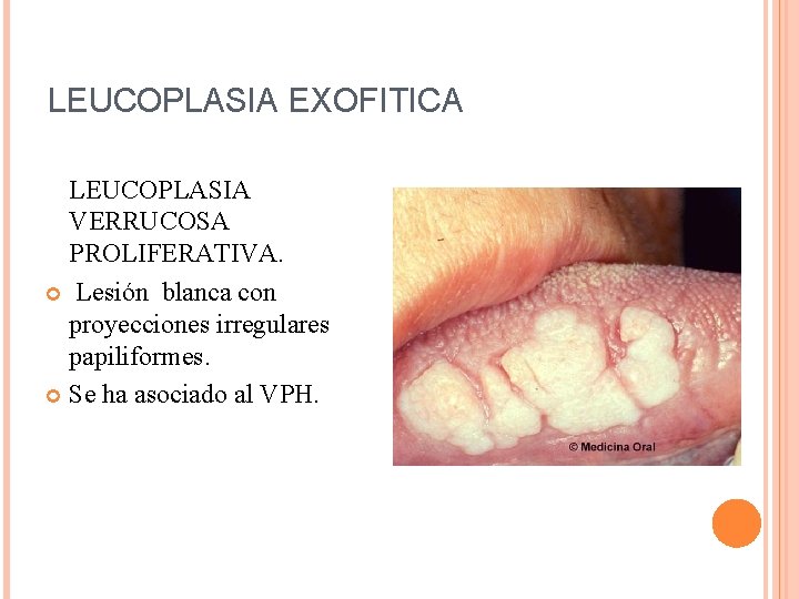 LEUCOPLASIA EXOFITICA LEUCOPLASIA VERRUCOSA PROLIFERATIVA. Lesión blanca con proyecciones irregulares papiliformes. Se ha asociado