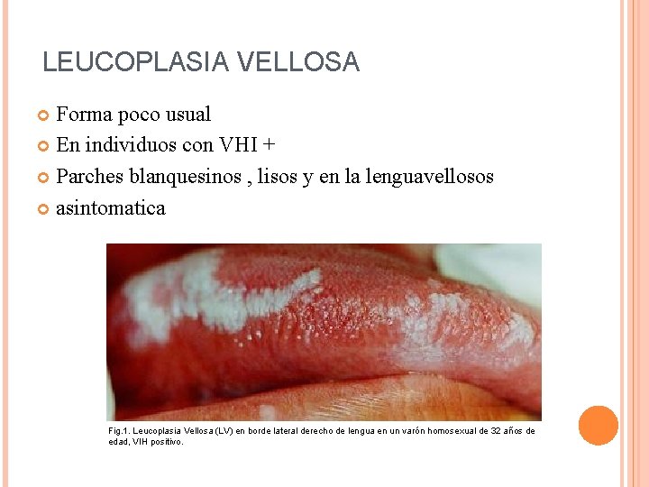 LEUCOPLASIA VELLOSA Forma poco usual En individuos con VHI + Parches blanquesinos , lisos