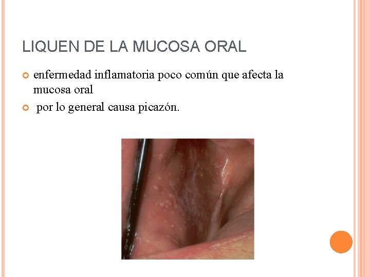 LIQUEN DE LA MUCOSA ORAL enfermedad inflamatoria poco común que afecta la mucosa oral