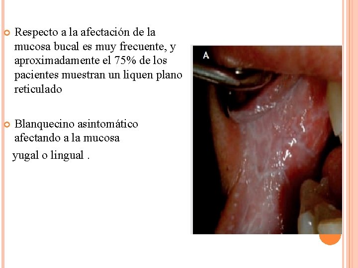  Respecto a la afectación de la mucosa bucal es muy frecuente, y aproximadamente