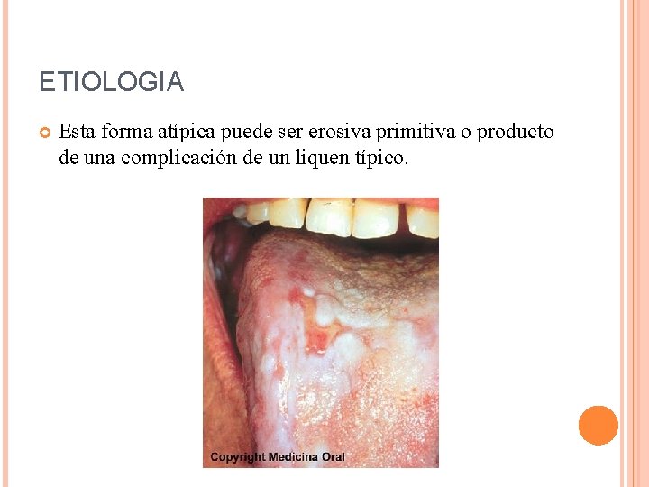 ETIOLOGIA Esta forma atípica puede ser erosiva primitiva o producto de una complicación de