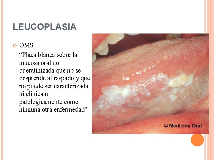 LEUCOPLASIA OMS “Placa blanca sobre la mucosa oral no queratinizada que no se desprende