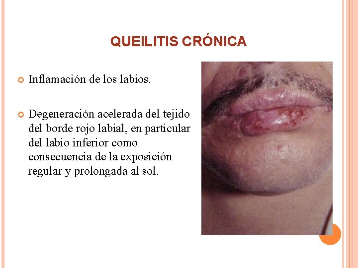 QUEILITIS CRÓNICA Inflamación de los labios. Degeneración acelerada del tejido del borde rojo labial,