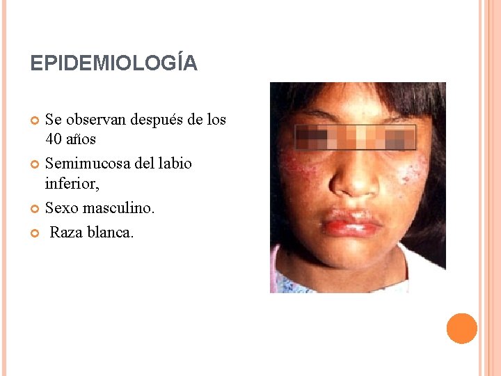 EPIDEMIOLOGÍA Se observan después de los 40 años Semimucosa del labio inferior, Sexo masculino.