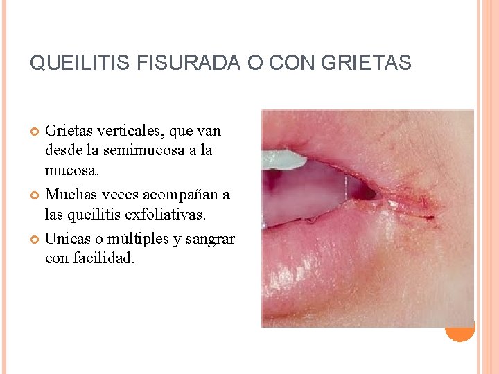 QUEILITIS FISURADA O CON GRIETAS Grietas verticales, que van desde la semimucosa a la