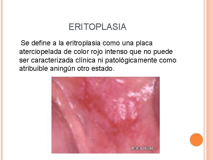 ERITOPLASIA Se define a la eritroplasia como una placa aterciopelada de color rojo intenso