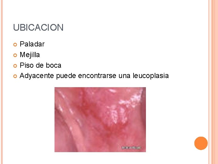 UBICACION Paladar Mejilla Piso de boca Adyacente puede encontrarse una leucoplasia 