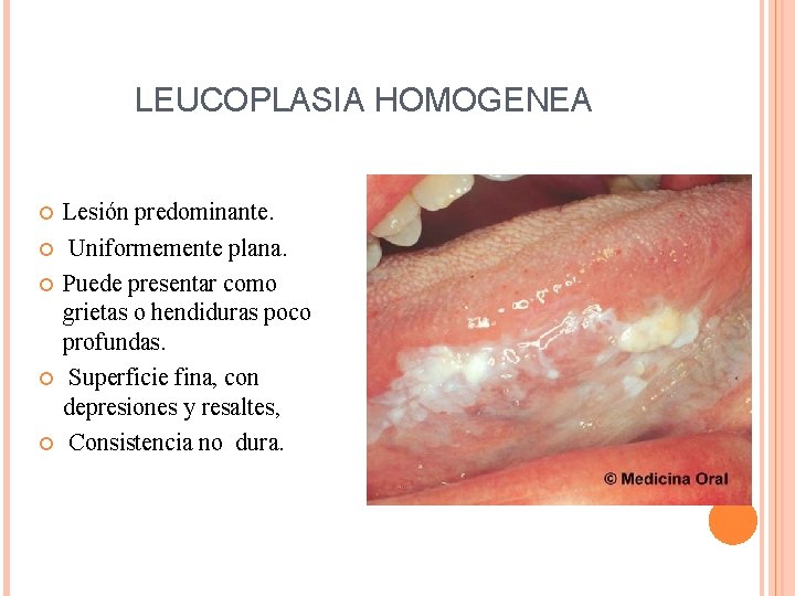 LEUCOPLASIA HOMOGENEA Lesión predominante. Uniformemente plana. Puede presentar como grietas o hendiduras poco profundas.