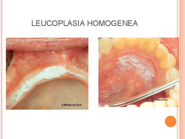 LEUCOPLASIA HOMOGENEA 