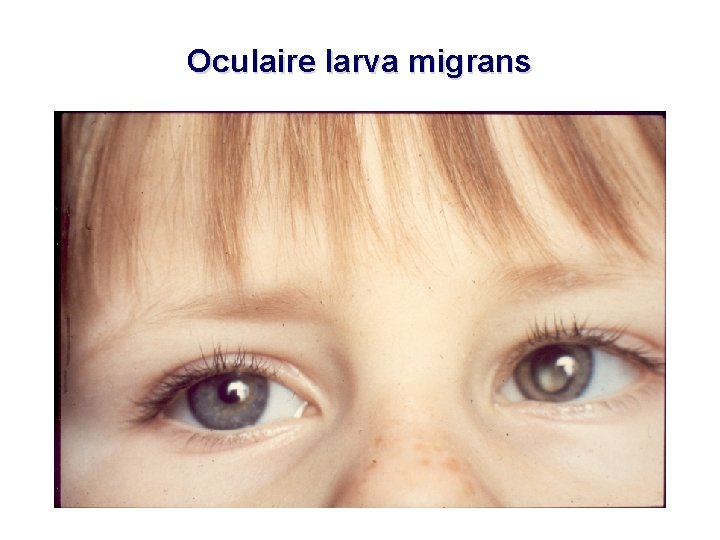 Oculaire larva migrans 