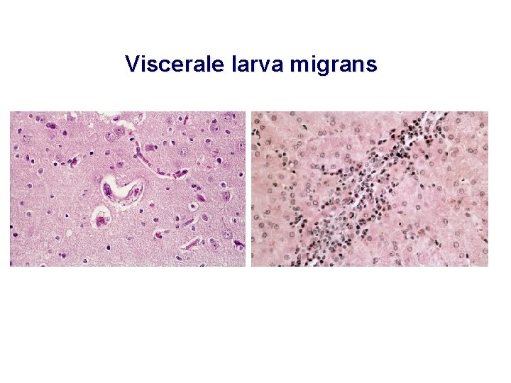 Viscerale larva migrans 