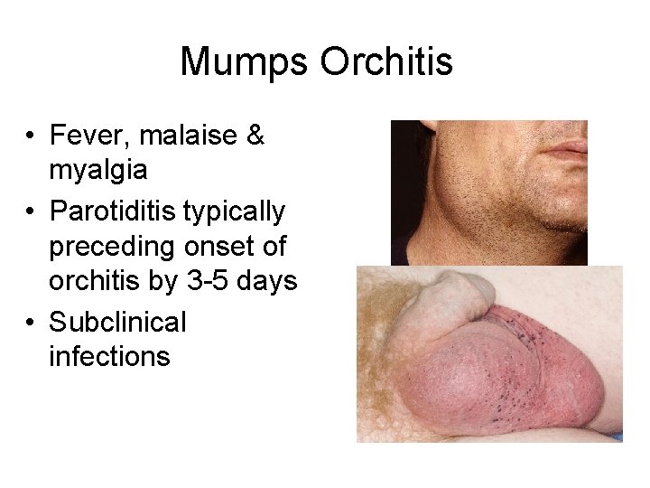 Mumps Orchitis • Fever, malaise & myalgia • Parotiditis typically preceding onset of orchitis