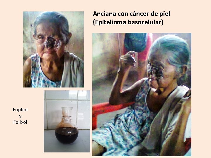 Anciana con cáncer de piel (Epitelioma basocelular) Euphol y Forbol 