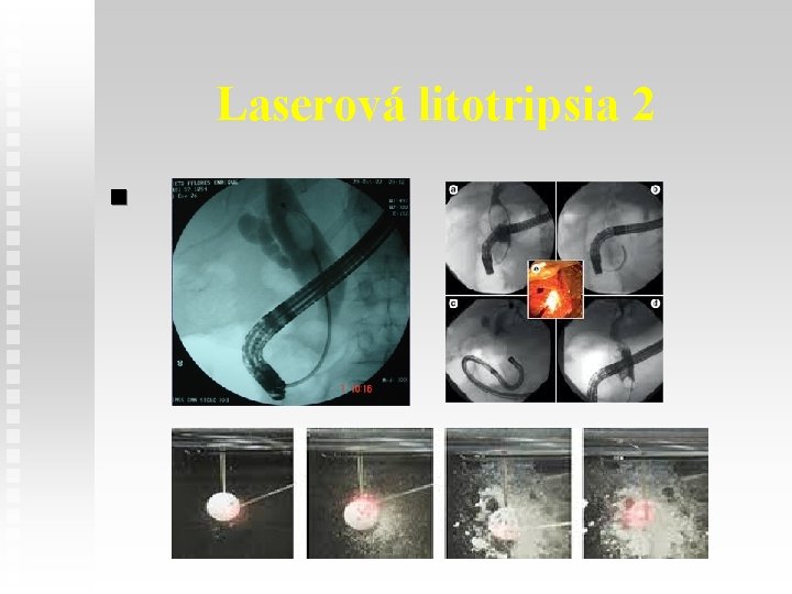 Laserová litotripsia 2 n 