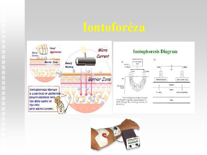 Iontoforéza 