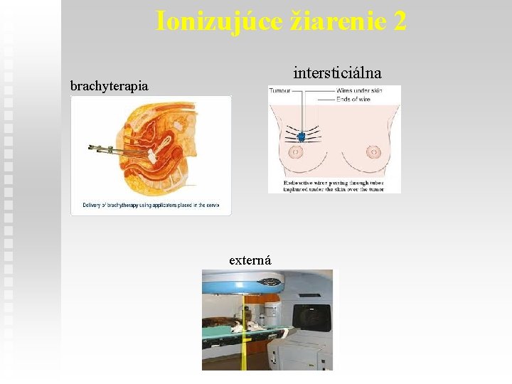 Ionizujúce žiarenie 2 intersticiálna brachyterapia externá 