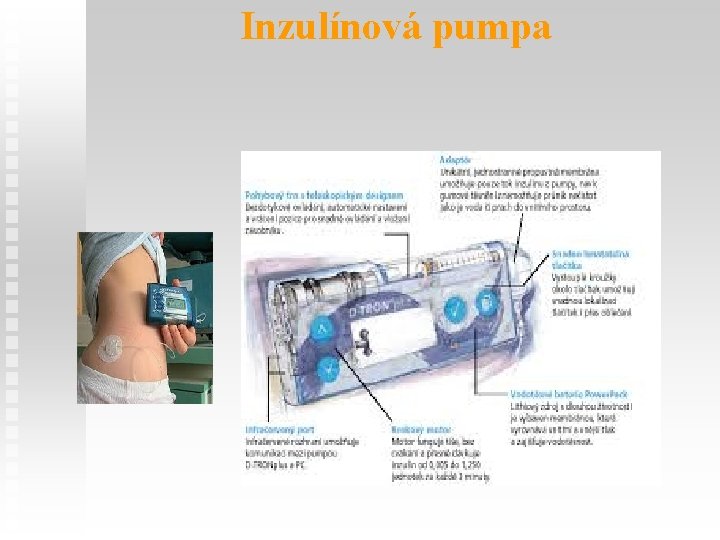 Inzulínová pumpa 