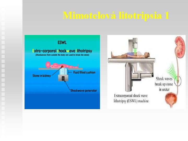 Mimotelová litotripsia 1 