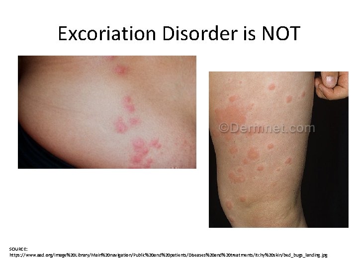 Excoriation Disorder is NOT SOURCE: https: //www. aad. org/Image%20 Library/Main%20 navigation/Public%20 and%20 patients/Diseases%20 and%20