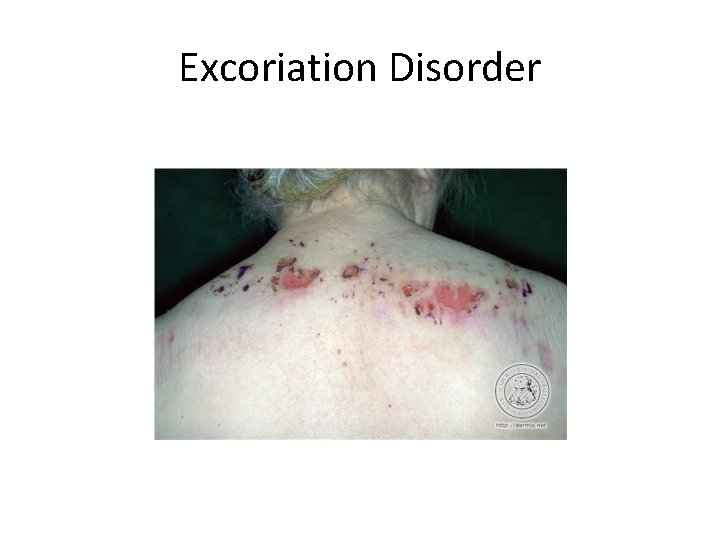 Excoriation Disorder 