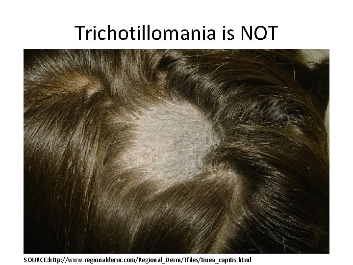 Trichotillomania is NOT SOURCE: http: //www. regionalderm. com/Regional_Derm/Tfiles/tinea_capitis. html 