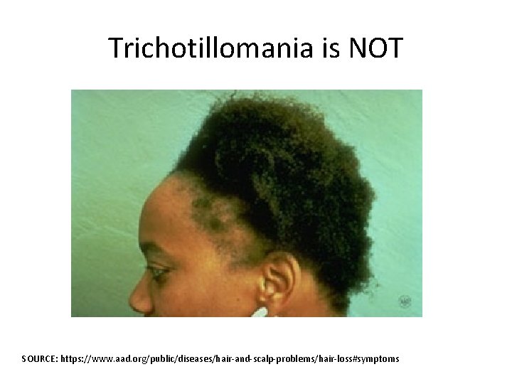 Trichotillomania is NOT SOURCE: https: //www. aad. org/public/diseases/hair-and-scalp-problems/hair-loss#symptoms 