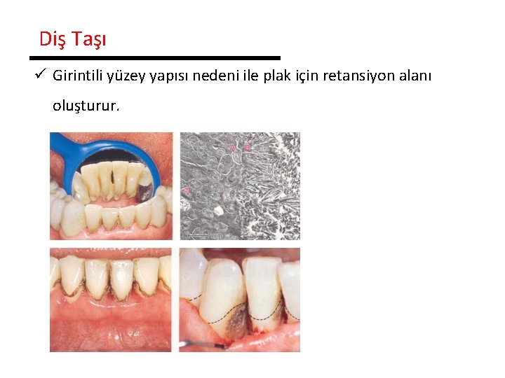 Diş Taşı ü Girintili yüzey yapısı nedeni ile plak için retansiyon alanı oluşturur. 