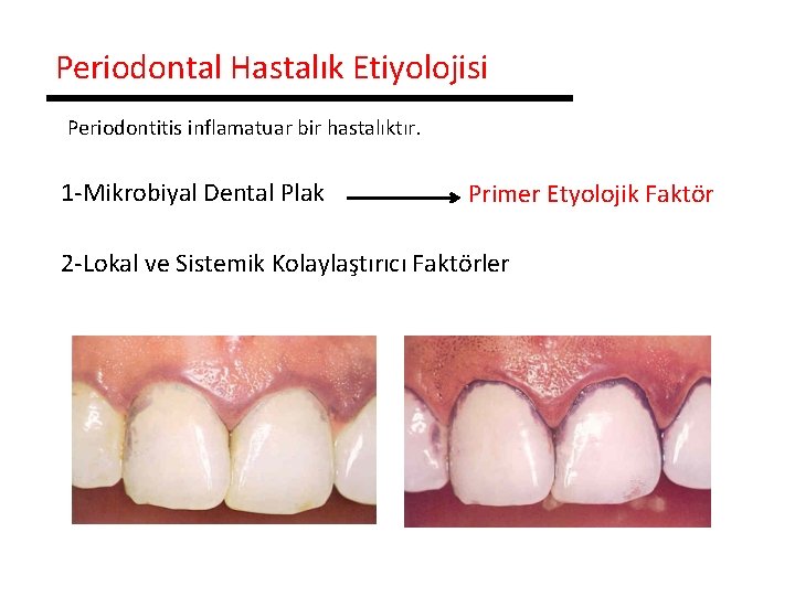 Periodontal Hastalık Etiyolojisi Periodontitis inflamatuar bir hastalıktır. 1 -Mikrobiyal Dental Plak Primer Etyolojik Faktör