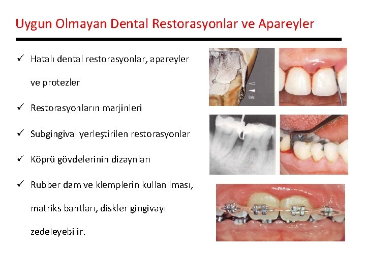 Uygun Olmayan Dental Restorasyonlar ve Apareyler ü Hatalı dental restorasyonlar, apareyler ve protezler ü