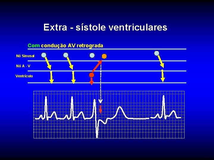 Extra - sístole ventriculares Com condução AV retrograda Nó Sinusal Nó A - V