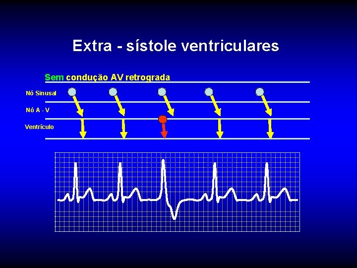 Extra - sístole ventriculares Sem condução AV retrograda Nó Sinusal Nó A - V