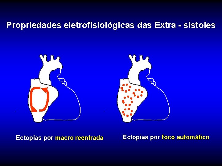 Propriedades eletrofisiológicas das Extra - sístoles Ectopias por macro reentrada Ectopias por foco automático