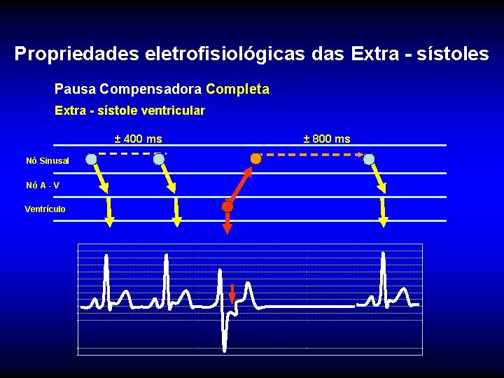 Propriedades eletrofisiológicas das Extra - sístoles Pausa Compensadora Completa Extra - sístole ventricular ±