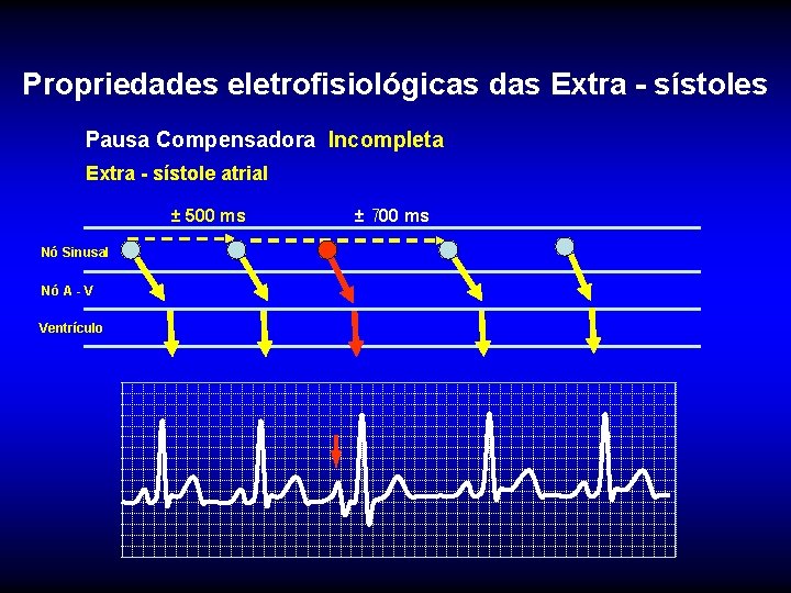 Propriedades eletrofisiológicas das Extra - sístoles Pausa Compensadora Incompleta Extra - sístole atrial ±
