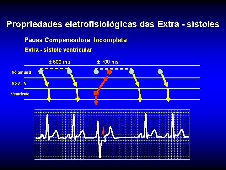 Propriedades eletrofisiológicas das Extra - sístoles Pausa Compensadora Incompleta Extra - sístole ventricular ±
