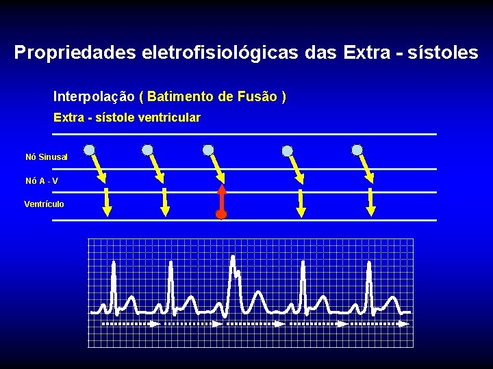 Propriedades eletrofisiológicas das Extra - sístoles Interpolação ( Batimento de Fusão ) Extra -
