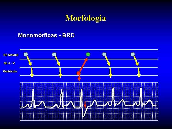Morfologia Monomórficas - BRD Nó Sinusal Nó A - V Ventrículo 