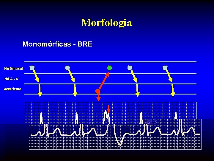 Morfologia Monomórficas - BRE Nó Sinusal Nó A - V Ventrículo 
