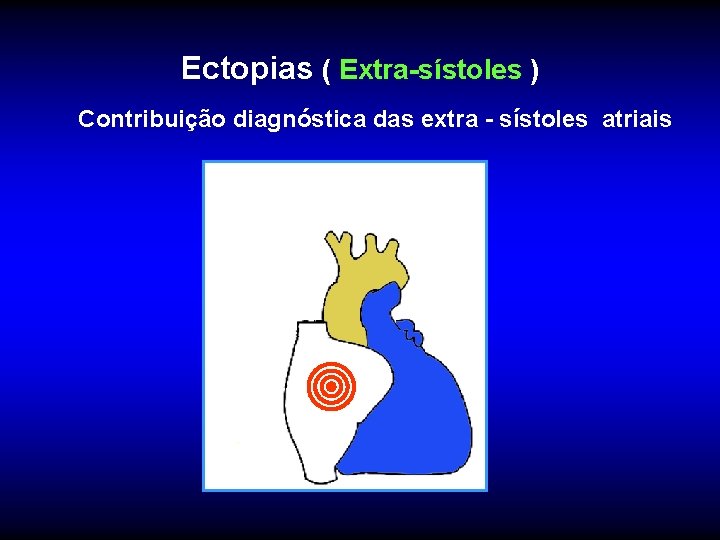 Ectopias ( Extra-sístoles ) Contribuição diagnóstica das extra - sístoles atriais 
