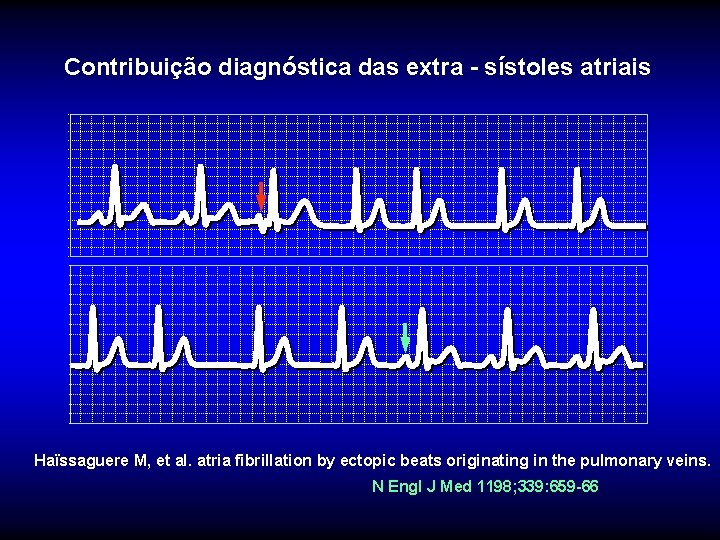 Contribuição diagnóstica das extra - sístoles atriais Haïssaguere M, et al. atria fibrillation by