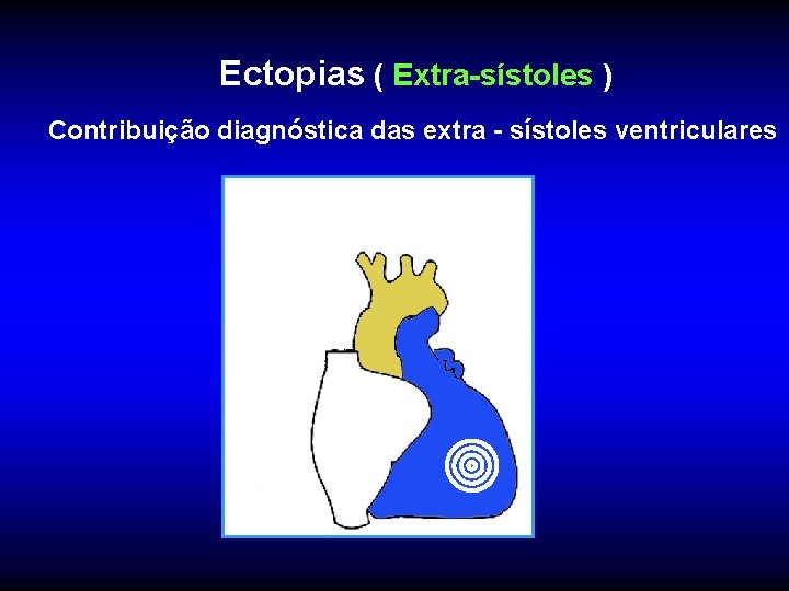 Ectopias ( Extra-sístoles ) Contribuição diagnóstica das extra - sístoles ventriculares 