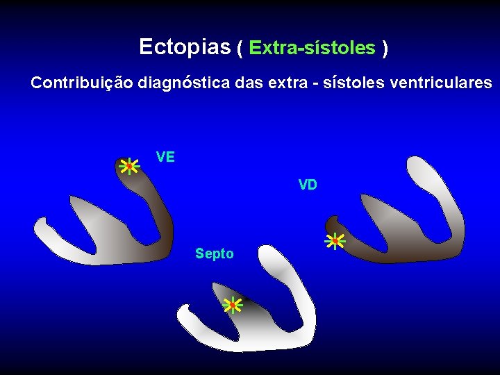 Ectopias ( Extra-sístoles ) Contribuição diagnóstica das extra - sístoles ventriculares VE VD Septo