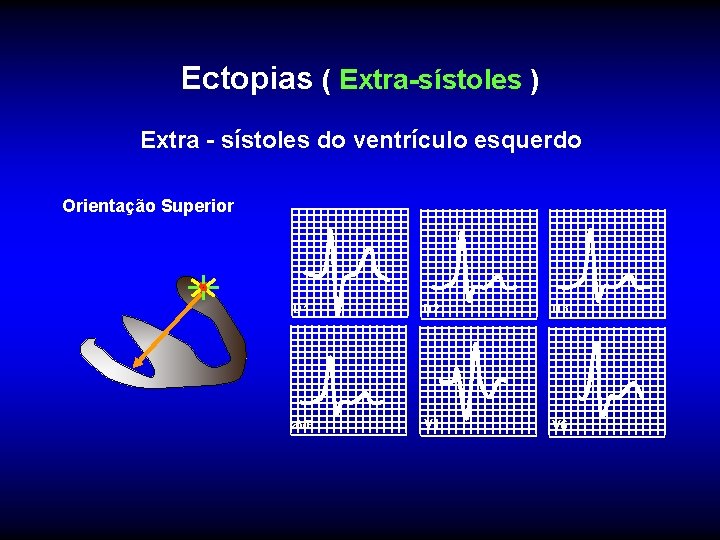 Ectopias ( Extra-sístoles ) Extra - sístoles do ventrículo esquerdo Orientação Superior D 1