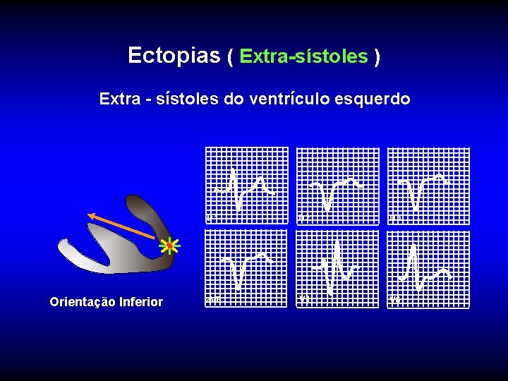 Ectopias ( Extra-sístoles ) Extra - sístoles do ventrículo esquerdo Orientação Inferior D 1