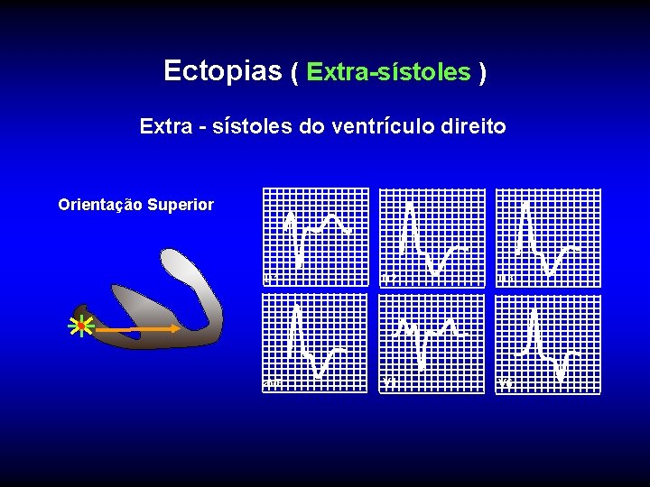 Ectopias ( Extra-sístoles ) Extra - sístoles do ventrículo direito Orientação Superior D 1