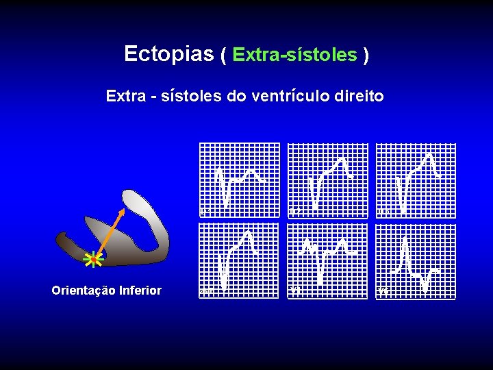 Ectopias ( Extra-sístoles ) Extra - sístoles do ventrículo direito Orientação Inferior D 1